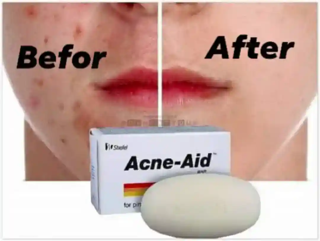 Acne aid soap